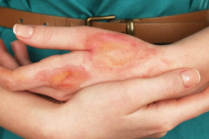 Fotografía de una mano con quemaduras de primer grado